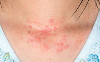Почему возникает аллергия на коже