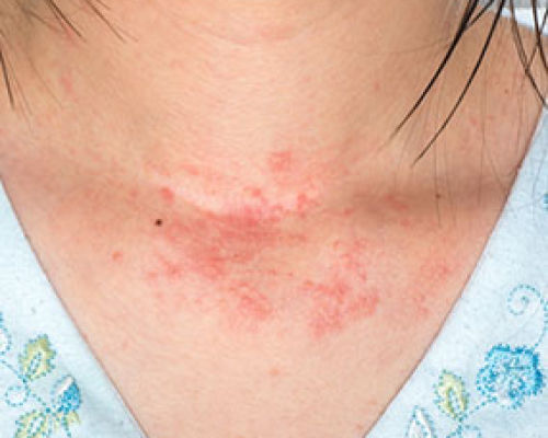 Why do skin allergies occur?