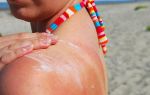 Аллергия на солнцезащитный крем: лечимся без последствий