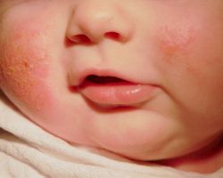 Алергічний дерматит у дітей.