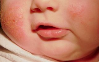 Аллергический дерматит у детей — информация для мам