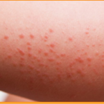 аллергическая сыпь на коже