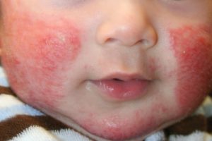 аллергический дерматит у детей