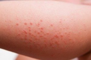 аллергический дерматит на коже