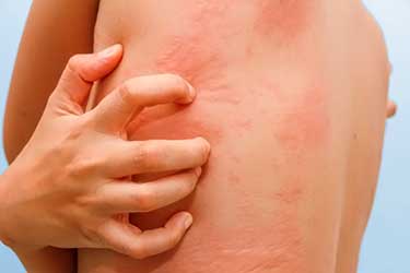 зуд от перекрёстной аллергии на коже