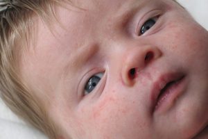 аллергическая сыпь на лице у ребёнка