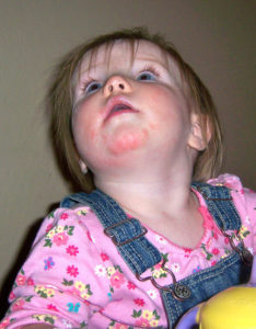 аллергическая реакция на клубнику у ребёнка