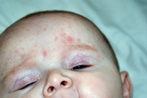 аллергическая сыпь от малины у ребёнка