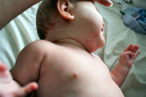 аллергия на малину у ребёнка