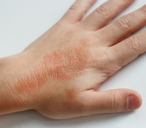 аллергическая реакция на коже рук