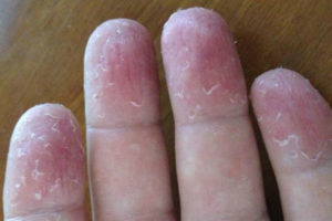 аллергия на руках