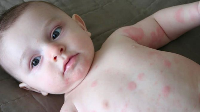 аллергия на дыню у ребенка